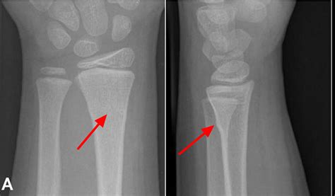 Greenstick Fracture Causes Healing Time Treatment