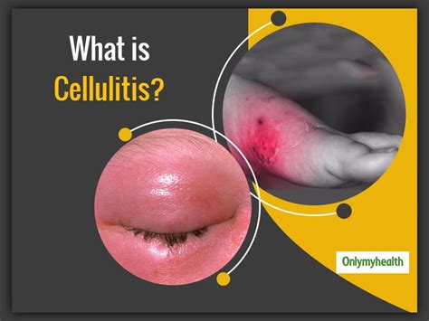 Cellulitis Signs And Symptoms