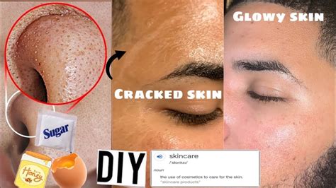 Transforming My Bfs Skin With Just 3 Products I Messed Up Your Skin