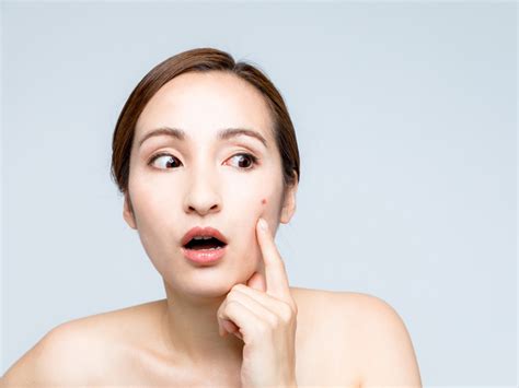 Jika anda sudah mencoba produk jerawat non resep selama beberapa minggu dan menghindari beberapa penyebab jerawat seperti di atas, namun kondisi tidak membaik maka anda harus berkonsultasi dengan dokter kulit untuk mendapatkan obat yang lebih kuat. 4 Kebiasaan Sepele yang Bikin Jerawat Makin Parah - Serba ...