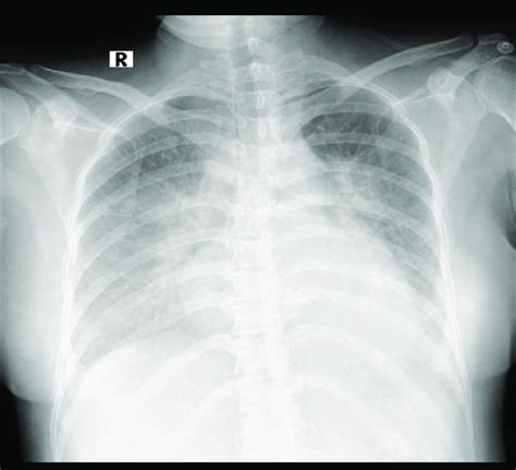 Plain Chest Radiograph At Admission Peribronchial Cuffing And An