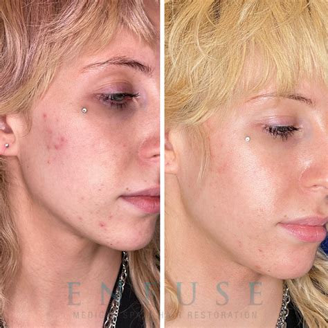 Acne Laser Treatment In Chicago Enfuse Medical Spa