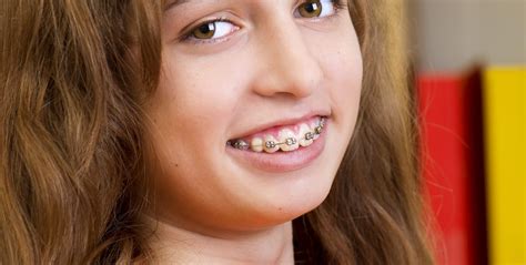 Taking Care Of Your Teeth With Braces A Lifetime Of Smiles