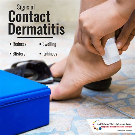 Signs Of Contact Dermatitis Health Tips From Kokilaben Hospital