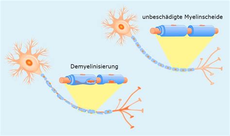 Dabei sind die aussichten allgemein besser als oft angenommen: Multiple Sklerose (MS) - Symptome, Diagnose und Behandlung ...