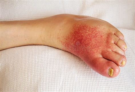 Erysipelas Of The Legs Red Rash On The Lective Focus Stock