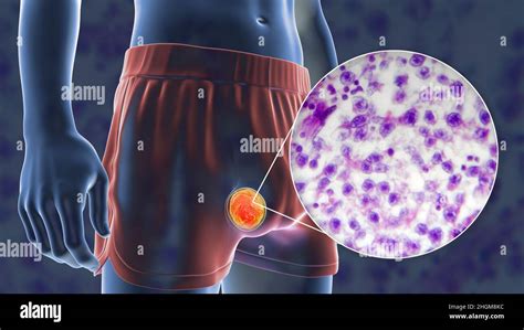 Testicular Cancer Illustration And Light Micrograph Stock Photo Alamy