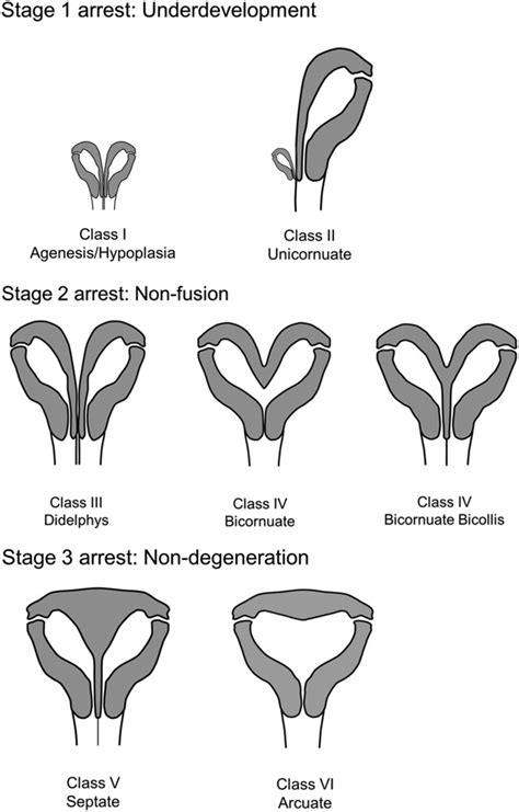 Uterus Types