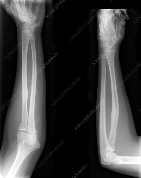 Healed Arm Bone Fracture X Rays Stock Image M3301768 Science