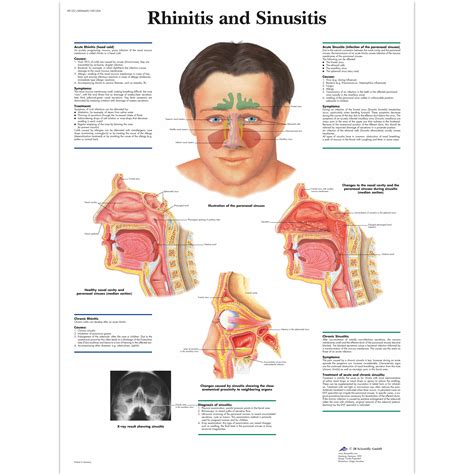Rhinitis And Sinusitis Chart 1001504 3b Scientific Vr1251l Ear