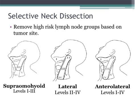 Neck Lymph Node Dissection02 Note Supraomohyoid Dissection Is A