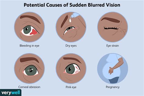 Whats Causing My Sudden Blurry Vision