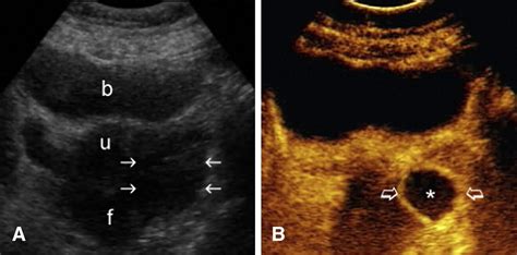 Echo Enhancers Could Facilitate The Sonographic Diagnosis Of Tubo