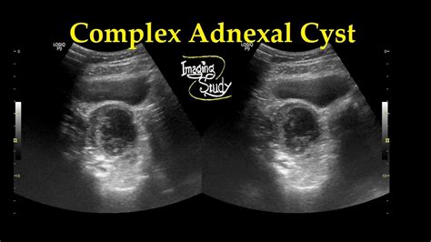 Complex Adnexal Cyst Ultrasound Case 27 YouTube