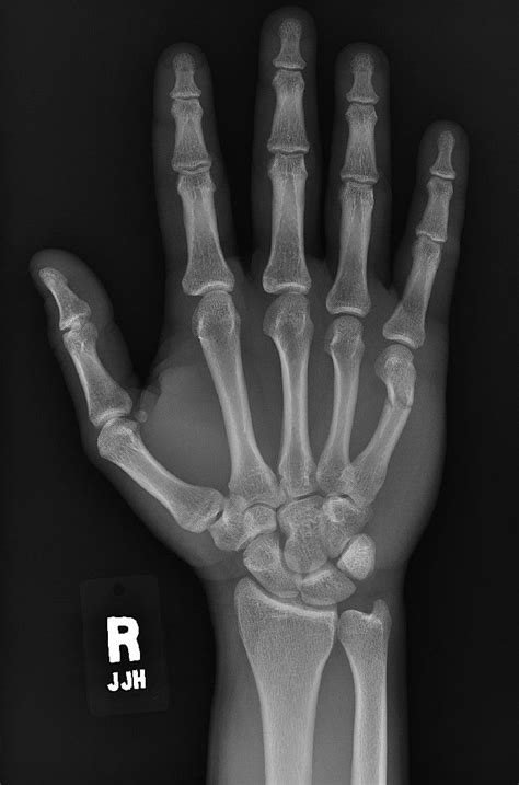 Pictures Of X Rays Normal Hand X Ray Look At My Boneer