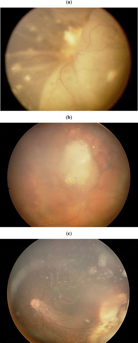Histopathologic Findings Of Eyes Enucleated After Treatment With
