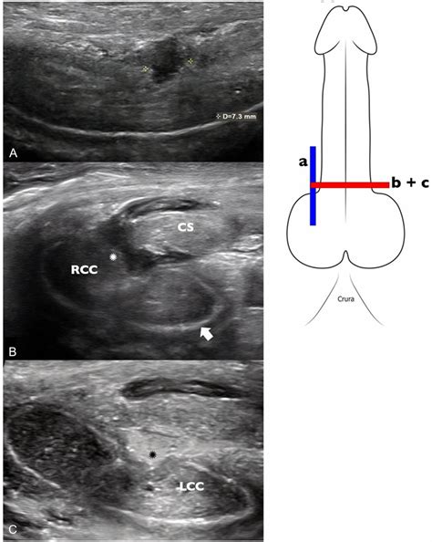 Microbubble Enhanced Ultrasound To Demonstrate Urethral Transection In