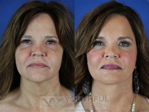 facelift reflection lift before and after photos patient 26 nashville tn youthful reflections