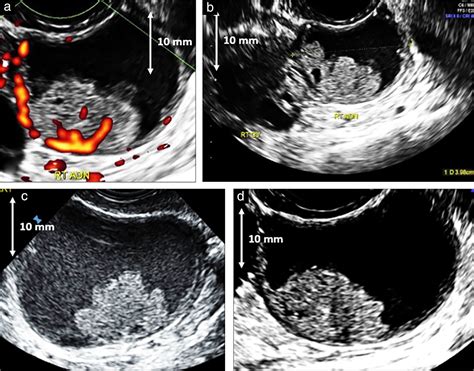 New Sonographic Marker Of Borderline Ovarian Tumor Microcystic Pattern