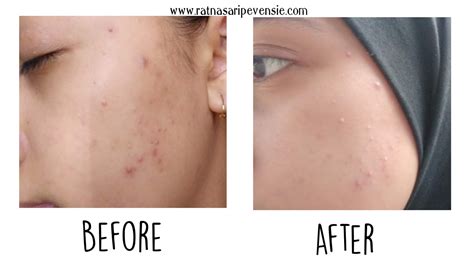 Ratnasari Pevensie's : Review: ERHA Acne Care Lab Series