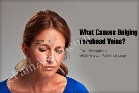 What Causes Bulging Forehead Veins And How Is It Treated