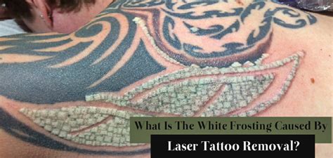 A nu u tattoo removal. What Is The White Frosting Caused By Laser Tattoo Removal ...