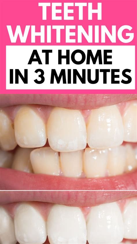 Pin On How To Get White Teeth Fast