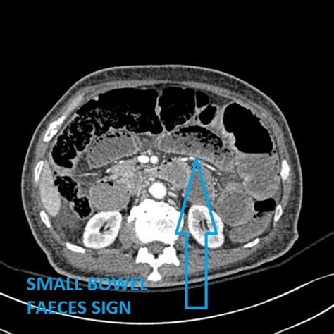 The Small Bowel Faeces Sign Can Be Observed On Abdominal Ct Scans The