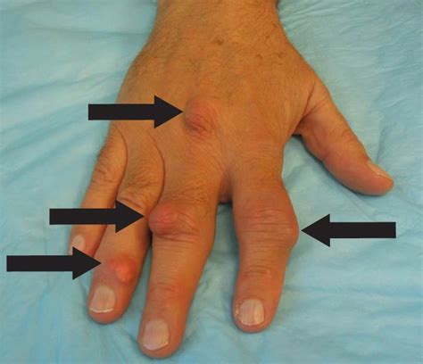 Tophi Along The Second Proximal Interphalangeal Gout Disease
