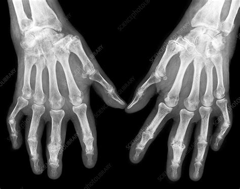 Haemochromatosis Hands X Ray Stock Image C0215430 Science