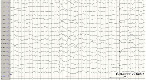 Interictal Eeg Right Temporal Sharp And Wave Discharge During Stage 2