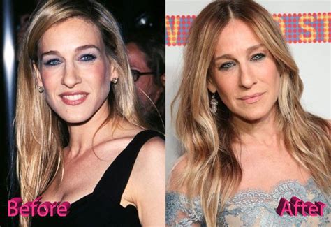 Sarah Jessica Parker Before And After Surgery Procedure Beauty Works