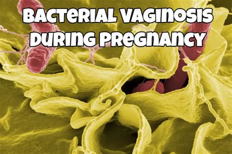 Bacterial Vaginosis During Pregnancy Causes And Treatment