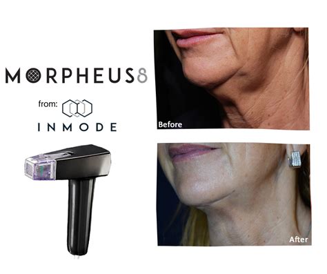 Morpheus8 Rf Microneedling Benefits Costs Results And Procedure Steps