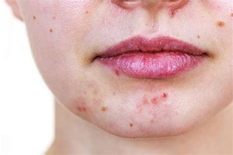 Chin Acne Identify The Cause Study Your Lifestyle