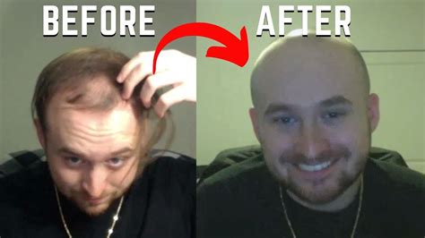 Going Bald At 20 Shaving My Head 1 Week Later Youtube