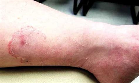 How Do You Solve A Problem Like This Leg Rash Clinician Reviews