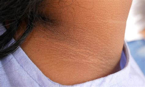 Acanthosis Nigricans What Is It Symptoms Causes And Treatment