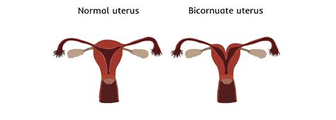 Heart Shaped Uterus Symptoms Causes Consequences On Fertility
