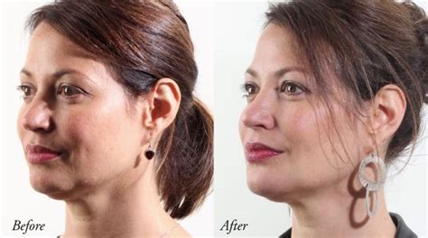 How To Get Rid Of Jowls Causes And Jowls Treatment