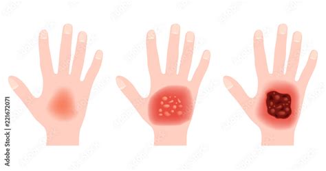 Step Of Burn Normal To Serious Burn Skin Vector And Icon Hand