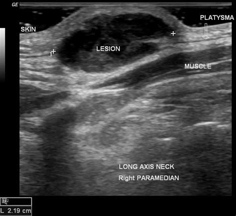 Thyroglossal Duct Cyst Image Radiopaedia Org