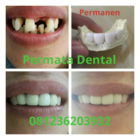 AHLI GIGI PALSU BALI PERMATA DENTAL : Merapikan Gigi Renggang Dengan
