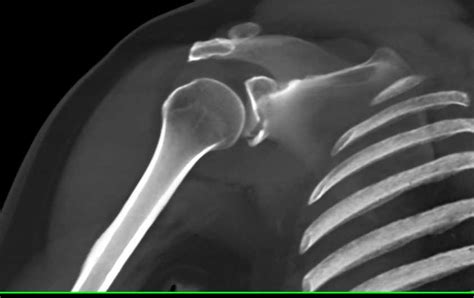 Fracture Of Inferior Rim Of The Glenoid Trauma Case Studies Ctisus