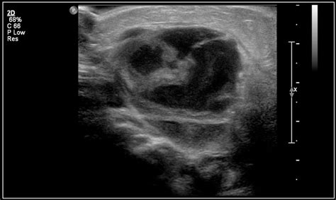 Lymph Node Vs Abscess Ultrasound