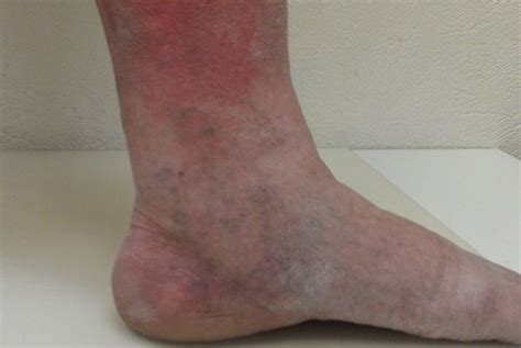 Blood Clot In Foot Symptoms Pictures Symptoms And Pictures