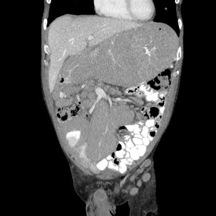 Small Bowel Lymphoma Radiology Reference Article Radiopaedia Org