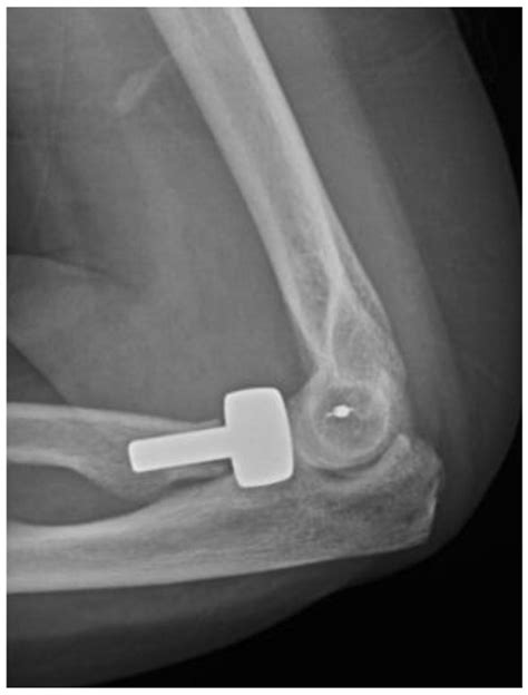 Complex Elbow Dislocations And The “terrible Triad” Injury