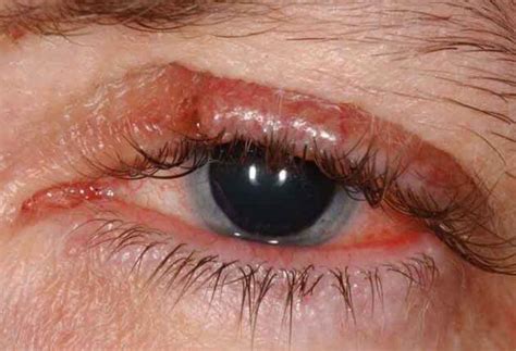 Eyelid Sebaceous Carcinoma Wills Eye Hospital