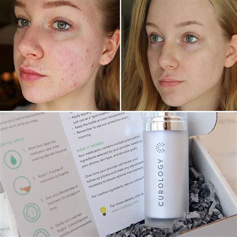 Get An Acne Prescription Made Just For You Made By Actual Dermatology